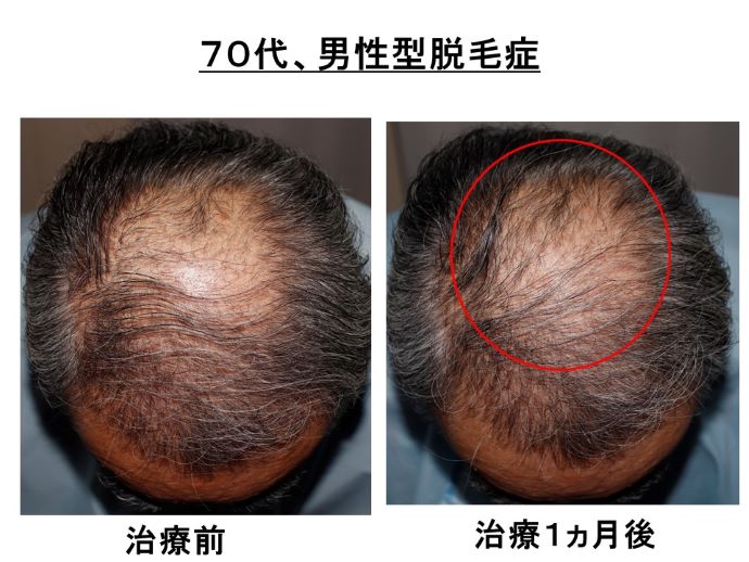 円形脱毛症　病院